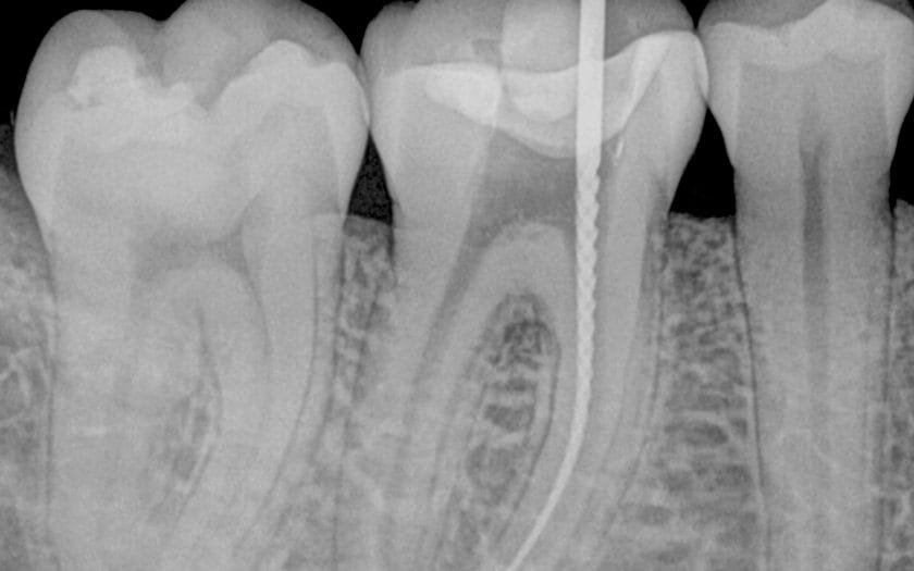 endodonzia san giorgio a cremano