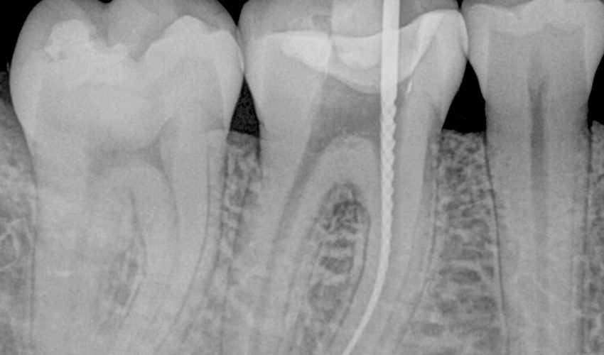 Endodonzia