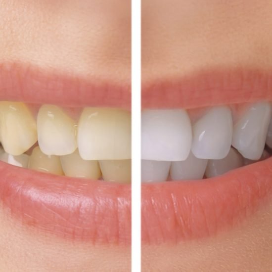 Sbiancamento Dentale Professionale