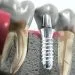 implantologia dentale san giorgio