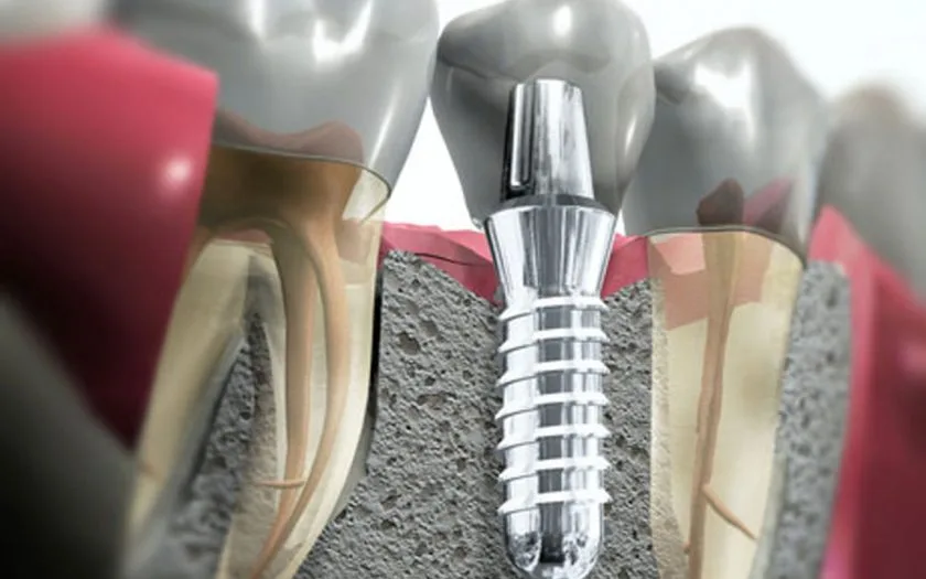 implantologia dentale san giorgio