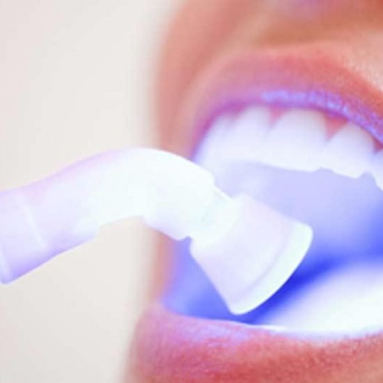 Sbiancamento Dentale Professionale