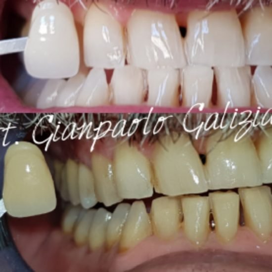 Sbiancamento Dentale Professionale