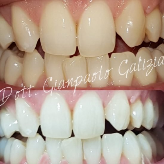 Sbiancamento Dentale Professionale