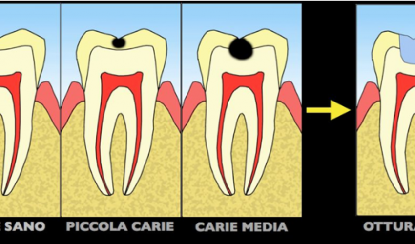 Cura Carie Conservativa Estetica