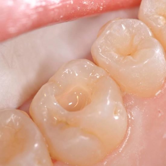 Cura Carie Conservativa Estetica
