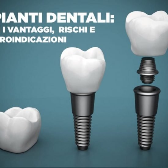 Implantologia Dentale