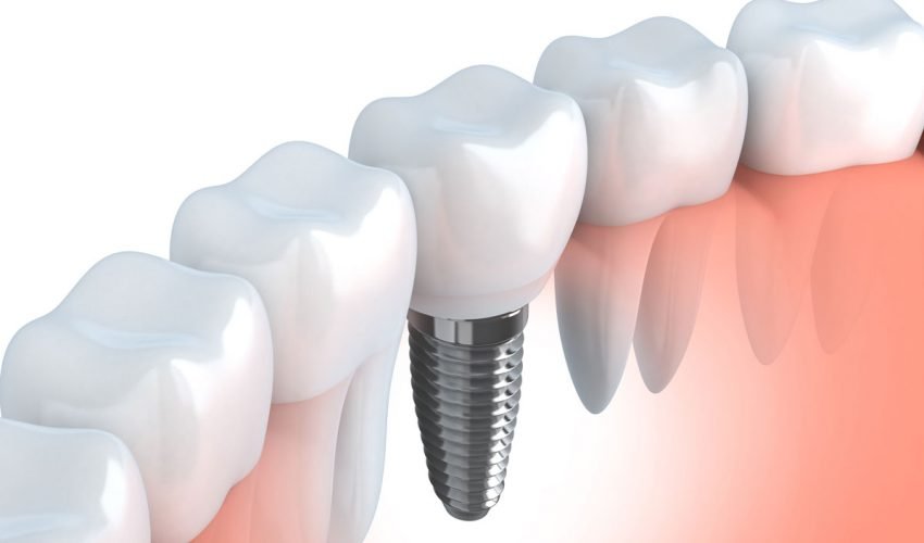 Implantologia Dentale
