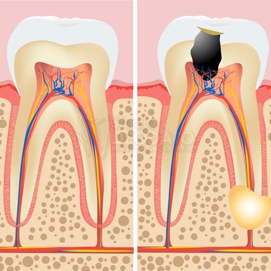 Cura Carie Conservativa Estetica